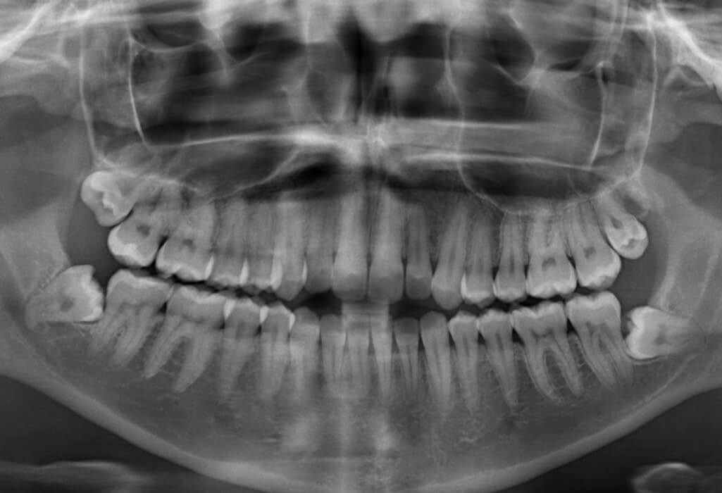 Black and white panoramic X-ray image of a patient with 32 teeth before wisdom teeth removal in McKinney, TX