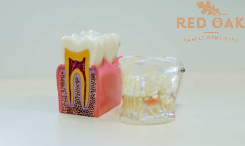Red Oak Family Dentistry - Root Canal - Blog Image