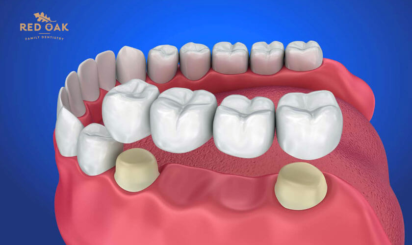 Featured image for “Dental Bridges: Cost & Benefits”