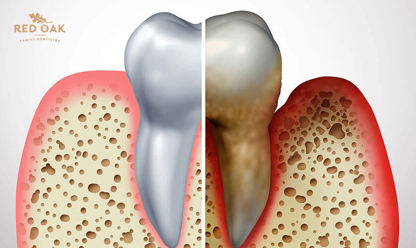 Featured image for “What are the various stages of gum disease?”