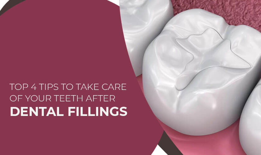 Top 4 Tips To Take Care Of Your Teeth After Dental Fillings