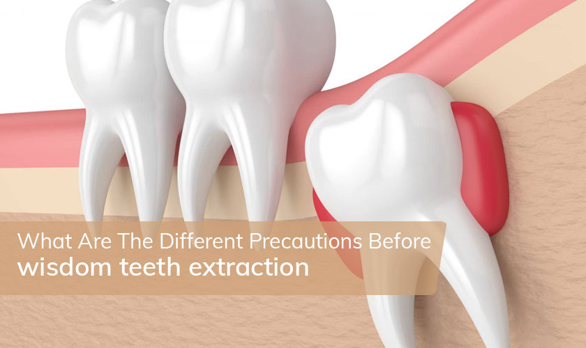 What Are The Different Precautions Before wisdom teeth extraction