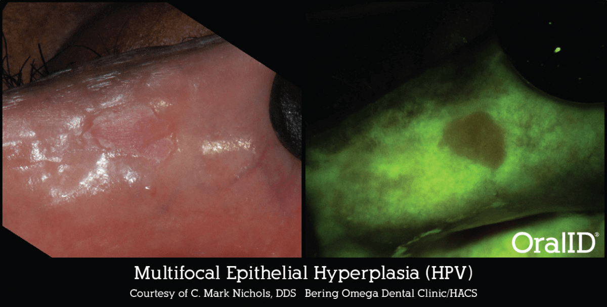 Enhanced-Oral-Cancer-Screening_image1