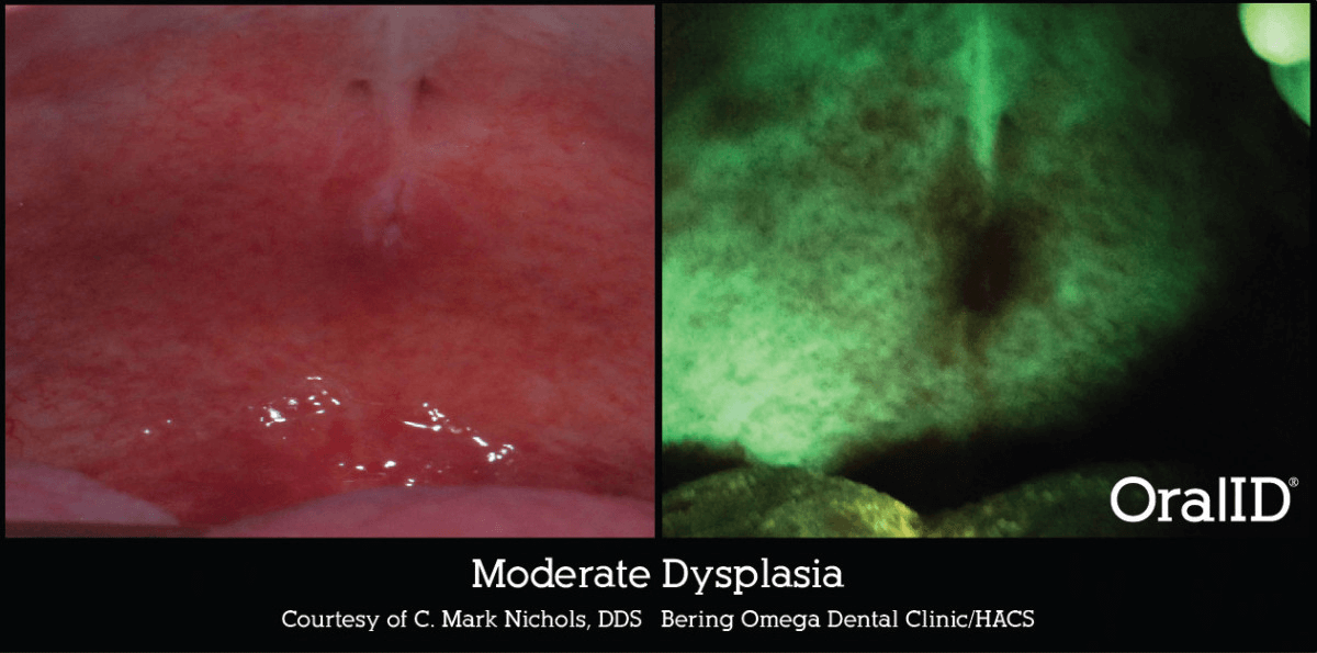 Enhanced-Oral-Cancer-Screening_image2