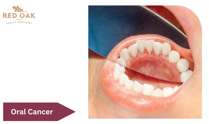 Featured image for “4 Common Myths And Reality About Oral Cancer”