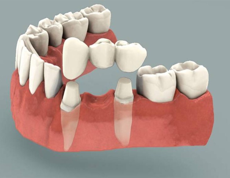 Featured image for “Can Dental Bridges Renew Your Smile And Boost Oral Health?”
