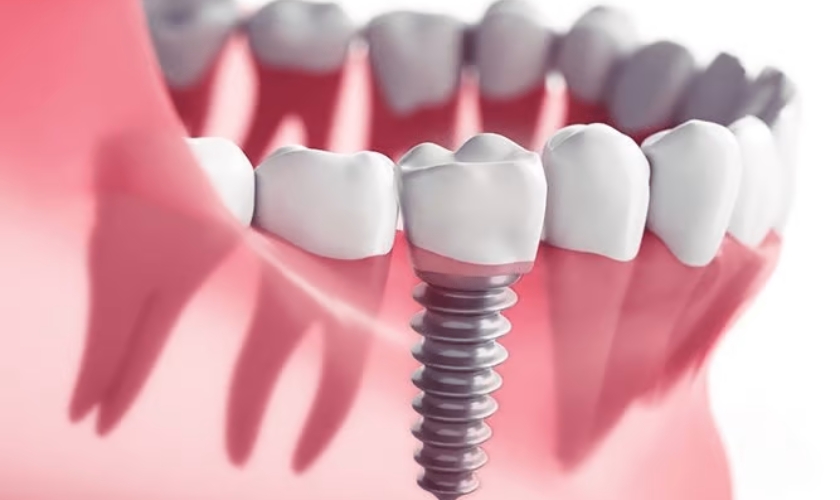 Featured image for “Are Dental Implants Right For You? Assessing Candidacy And Eligibility”