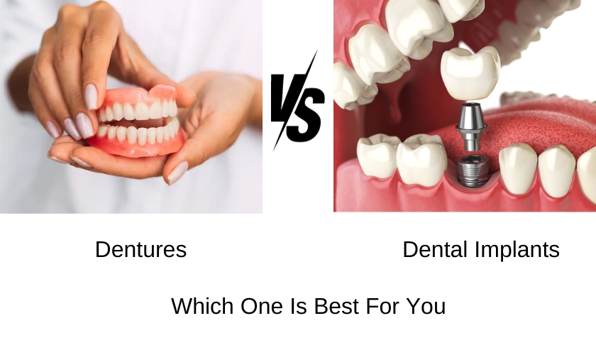 Image of dental implants-dental implants vs. dentures which one is best for you