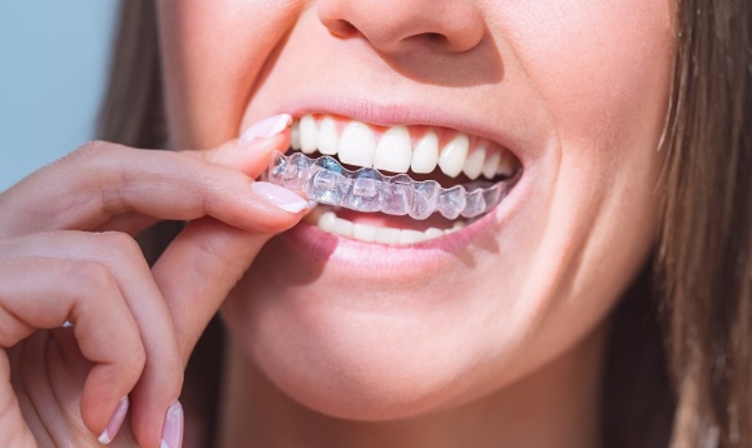 Featured image for “Choosing The Right Invisalign Dentist: Key Factors To Consider”