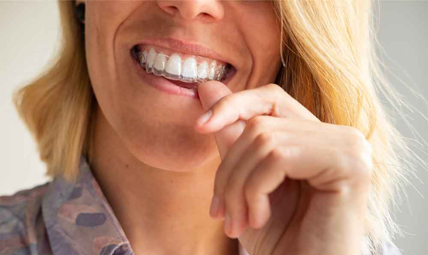 How To Use Dental Invisalign
