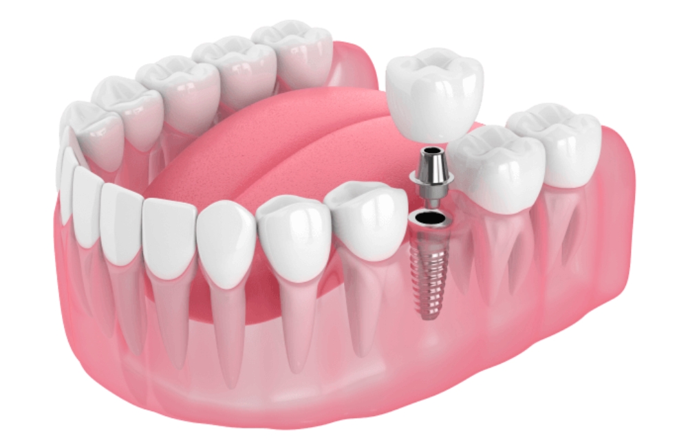 Featured image for “What Are The New Trends In Dental Implants”