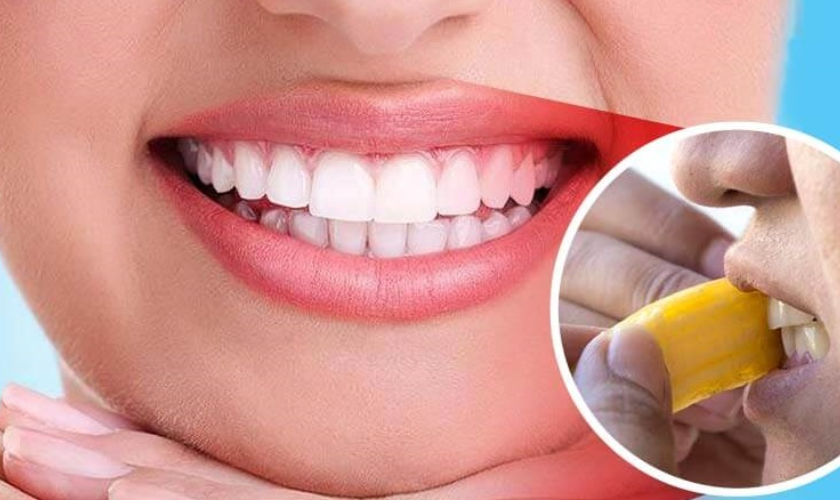 Featured image for “Do Banana Peels Whiten Teeth? Guide By Cosmetic Dentist”