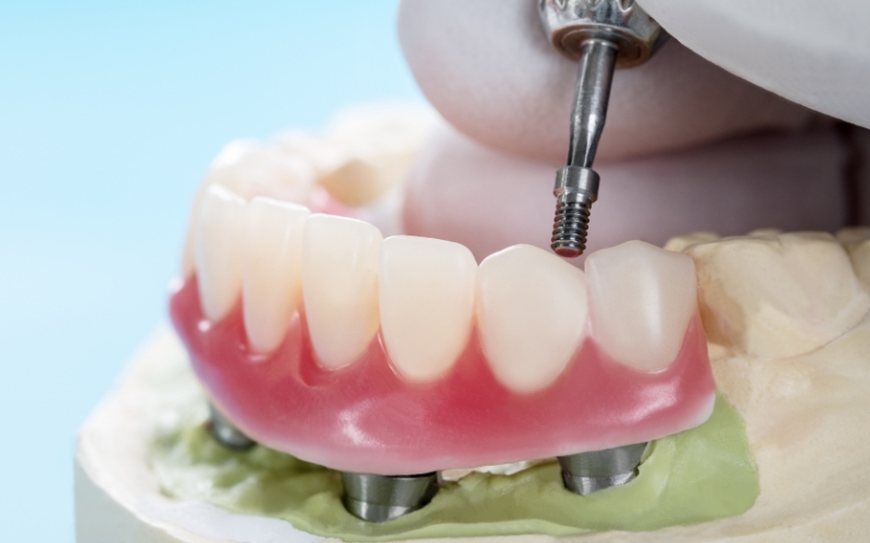 do dental implants have fake gums