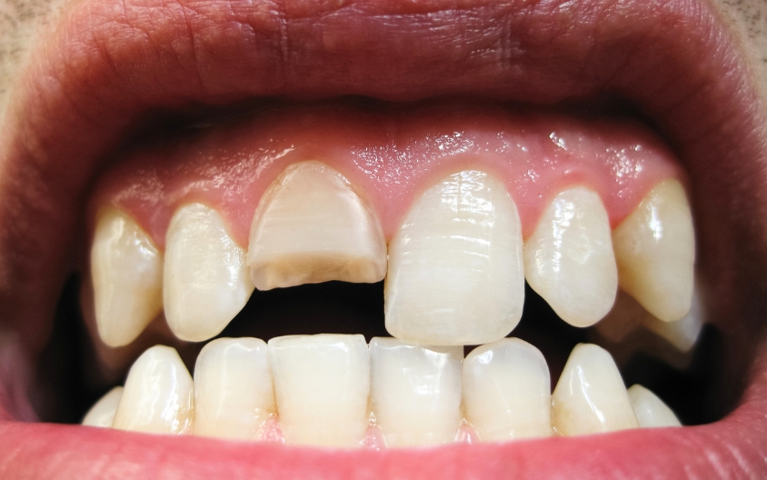 Featured image for “Cracked Tooth Causing Pain? Seeking Emergency Dental Treatment”